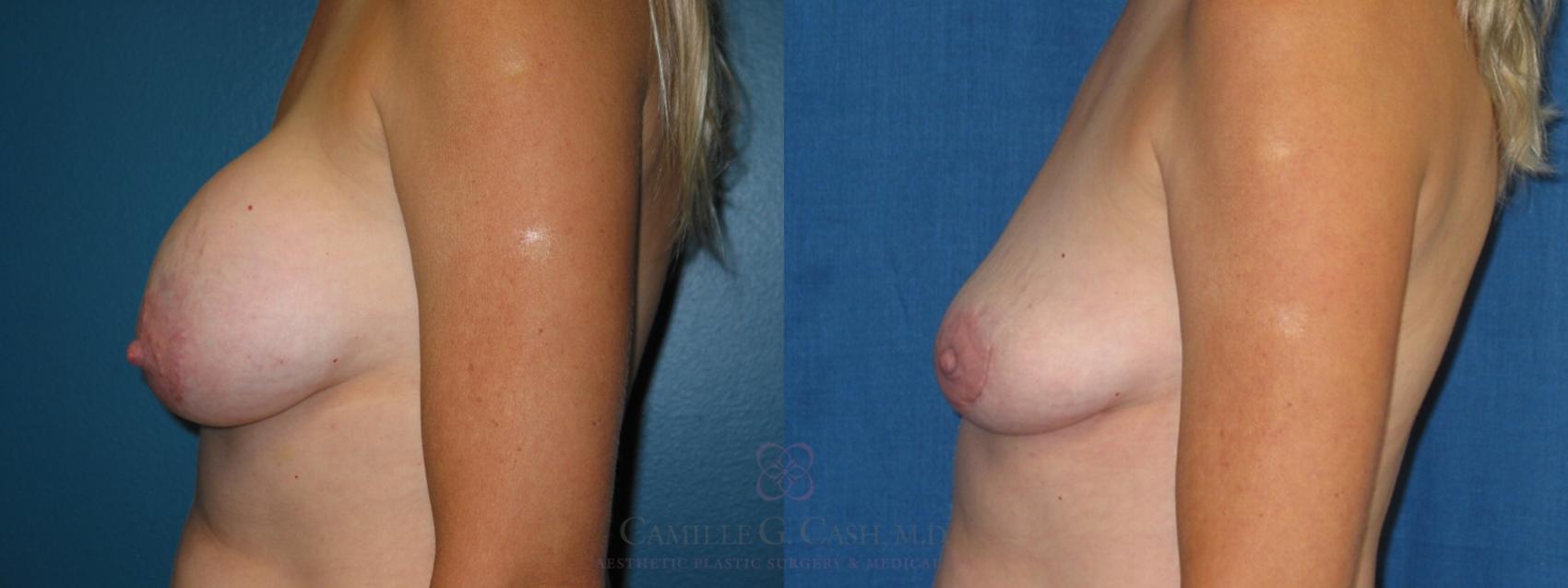 Before & After Breast Implant Removal Case 182 View #4 View in Houston, TX
