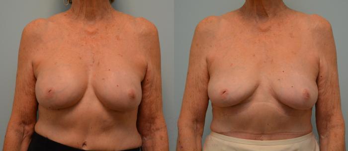 Before & After Breast Implant Removal Case 196 View #1 View in Houston, TX