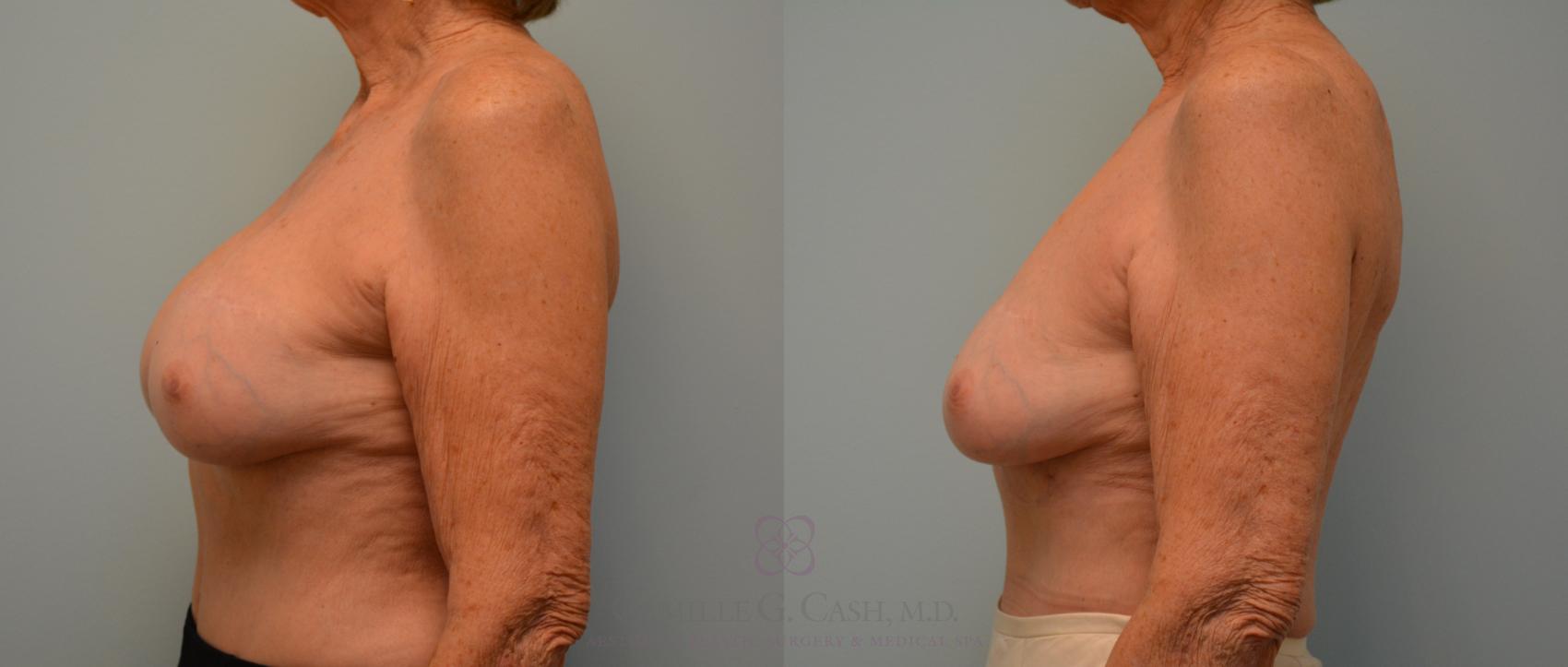 Before & After Breast Implant Removal Case 196 View #2 View in Houston, TX
