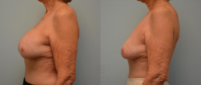 Before & After Breast Implant Removal Case 196 View #2 View in Houston, TX