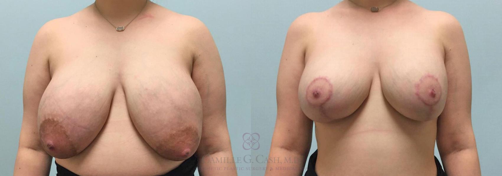 Before & After Breast Implant Removal Case 300 View #1 View in Houston, TX