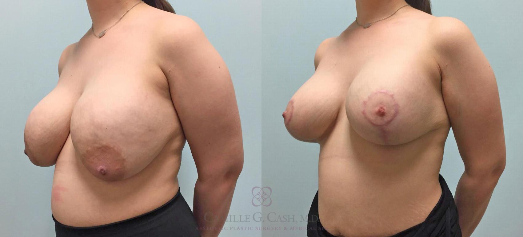 Before & After Breast Implant Removal Case 300 View #2 View in Houston, TX