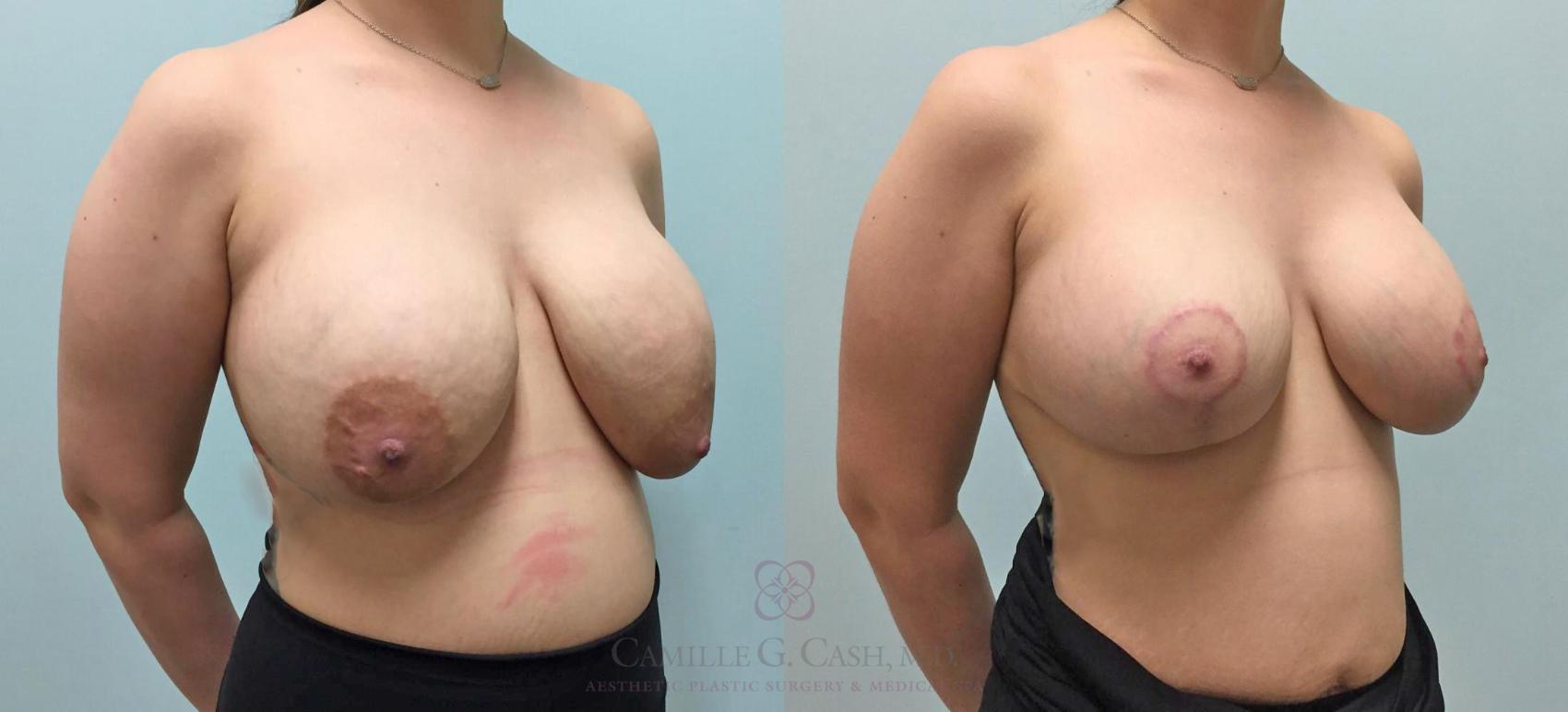 Before & After Breast Implant Removal Case 300 View #3 View in Houston, TX