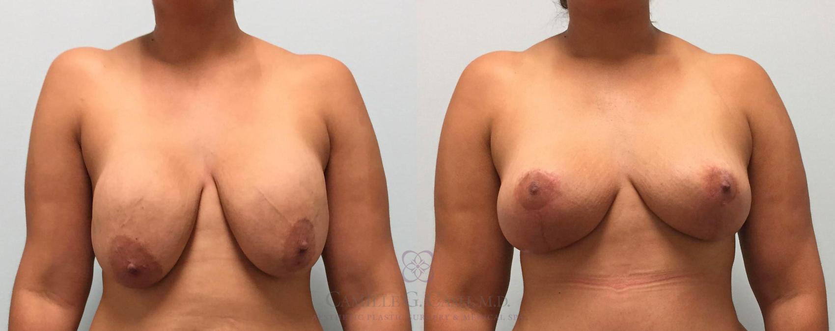 Before & After Breast Implant Removal Case 301 View #1 View in Houston, TX