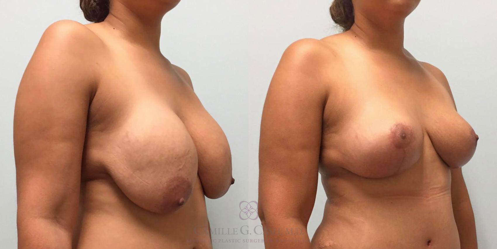 Before & After Breast Implant Removal Case 301 View #2 View in Houston, TX
