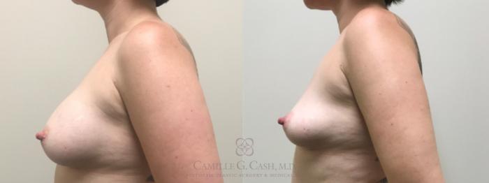 Before & After Breast Implant Removal Case 331 Left Side View in Houston, TX