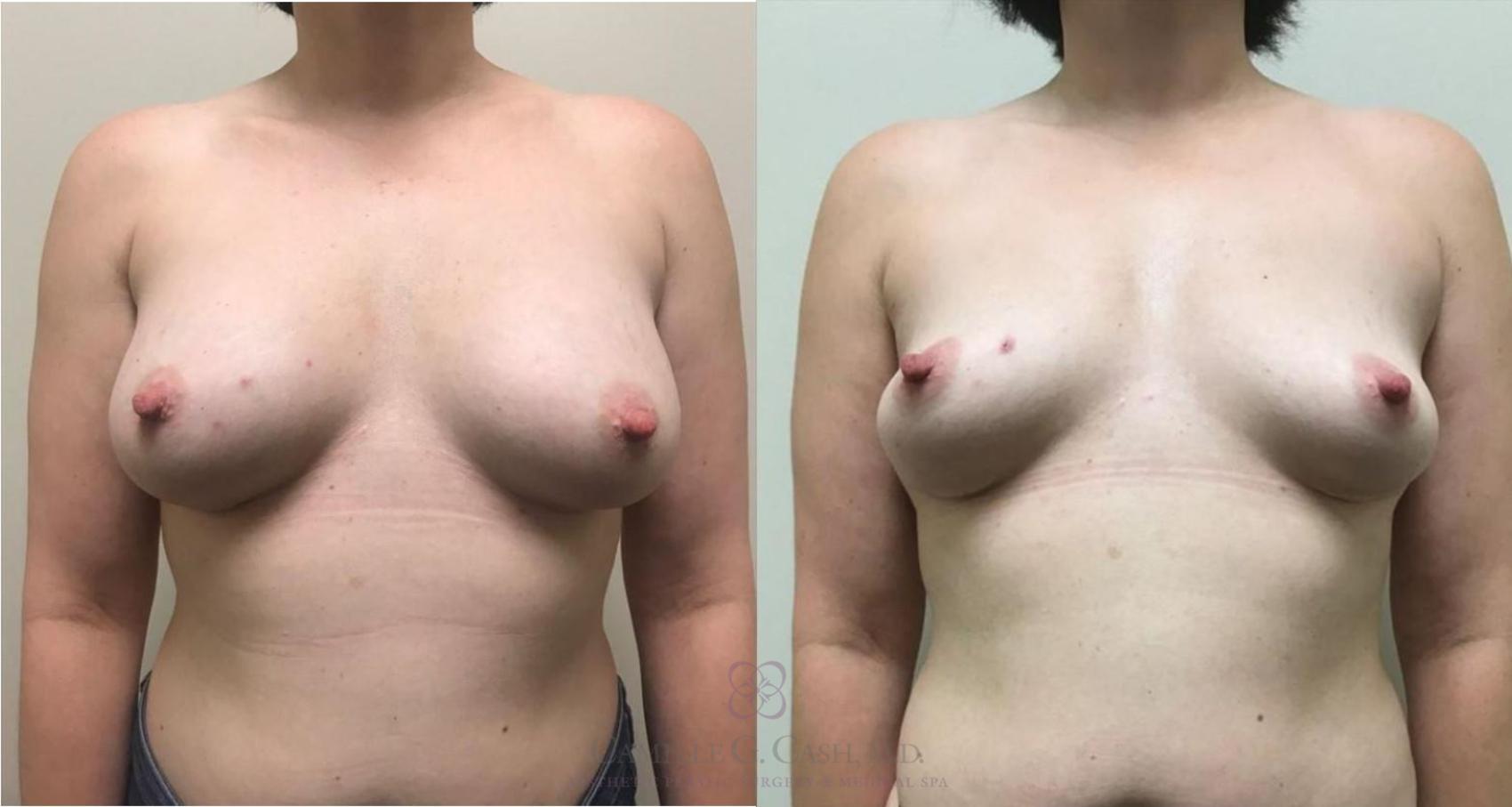 Before & After Breast Implant Removal Case 331 View #1 View in Houston, TX