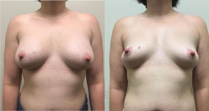 Before & After Breast Implant Removal Case 331 View #1 View in Houston, TX