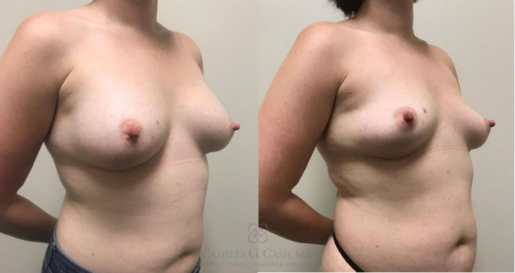 Before & After Breast Implant Removal Case 331 View #2 View in Houston, TX