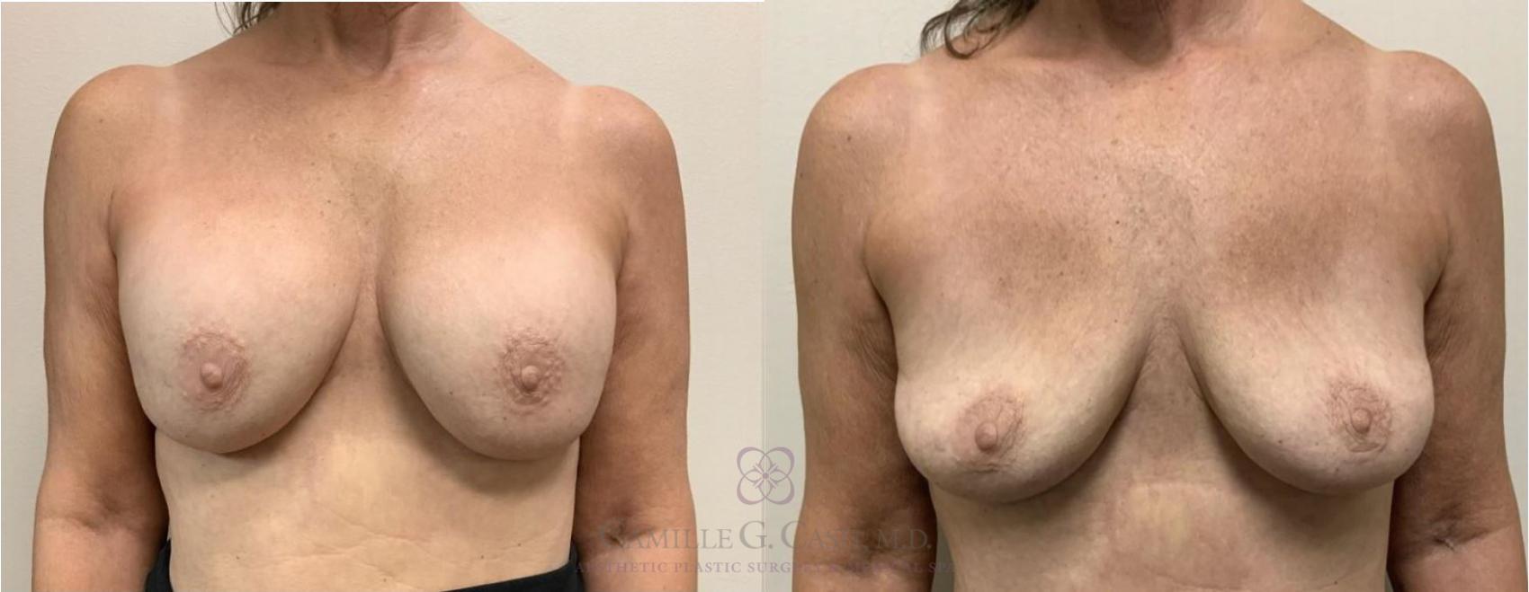 Before & After Breast Implant Removal Case 333 View #1 View in Houston, TX