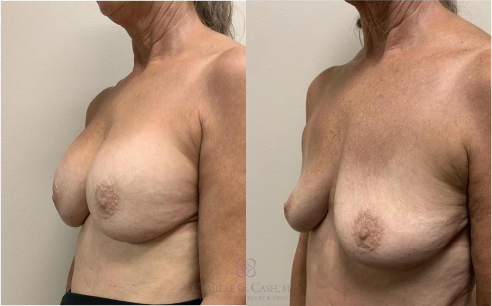 Before & After Breast Implant Removal Case 333 View #2 View in Houston, TX
