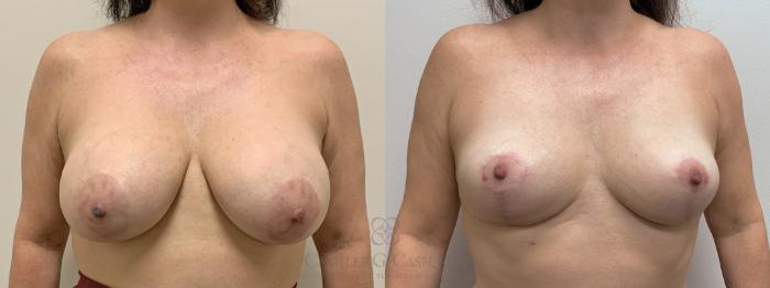 Before & After Breast Implant Removal Case 397 View #1 View in Houston, TX