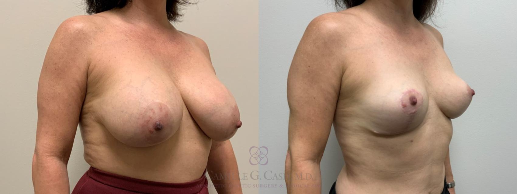 Before & After Breast Implant Removal Case 397 View #2 View in Houston, TX