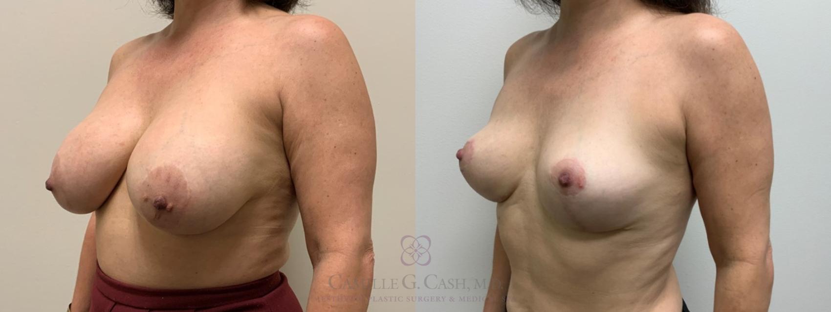 Before & After Breast Implant Removal Case 397 View #3 View in Houston, TX