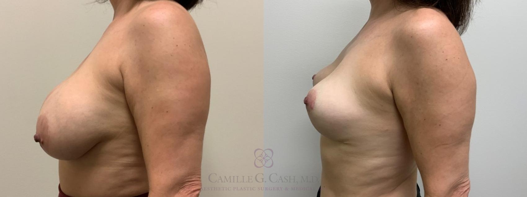 Before & After Breast Implant Removal Case 397 View #4 View in Houston, TX