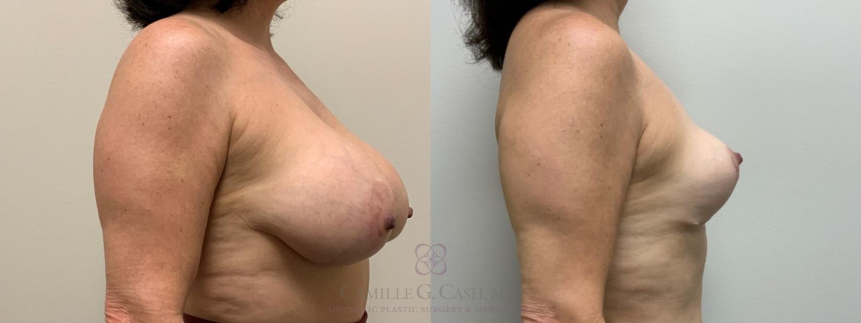 Before & After Breast Implant Removal Case 397 View #5 View in Houston, TX