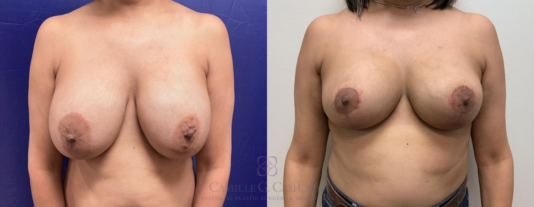 Before & After Breast Implant Removal Case 409 View #1 View in Houston, TX