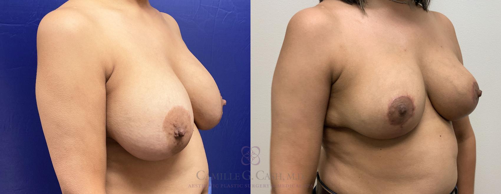 Before & After Breast Implant Removal Case 409 View #2 View in Houston, TX