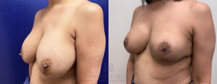 Before & After Breast Implant Removal Case 409 View #3 View in Houston, TX