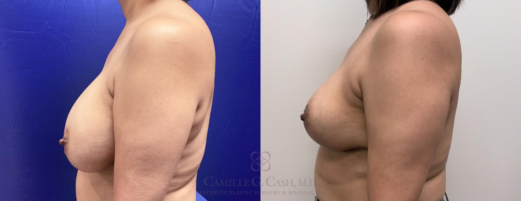 Before & After Breast Implant Removal Case 409 View #4 View in Houston, TX