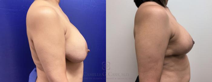 Before & After Breast Implant Removal Case 409 View #5 View in Houston, TX