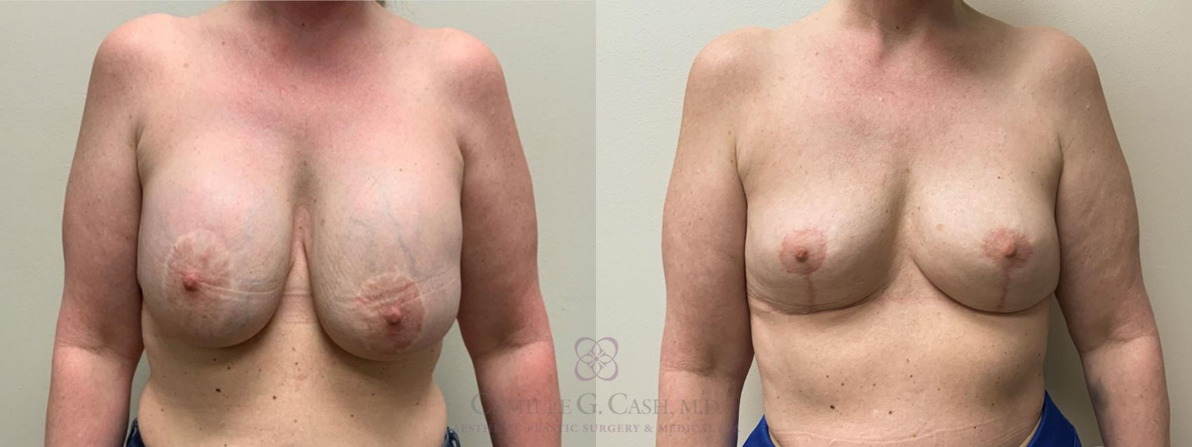 Before & After Breast Implant Removal Case 419 View #1 View in Houston, TX