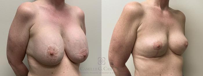 Before & After Breast Implant Removal Case 419 View #2 View in Houston, TX