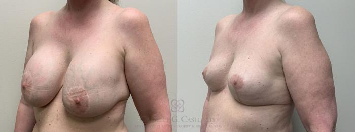 Before & After Breast Implant Removal Case 419 View #3 View in Houston, TX