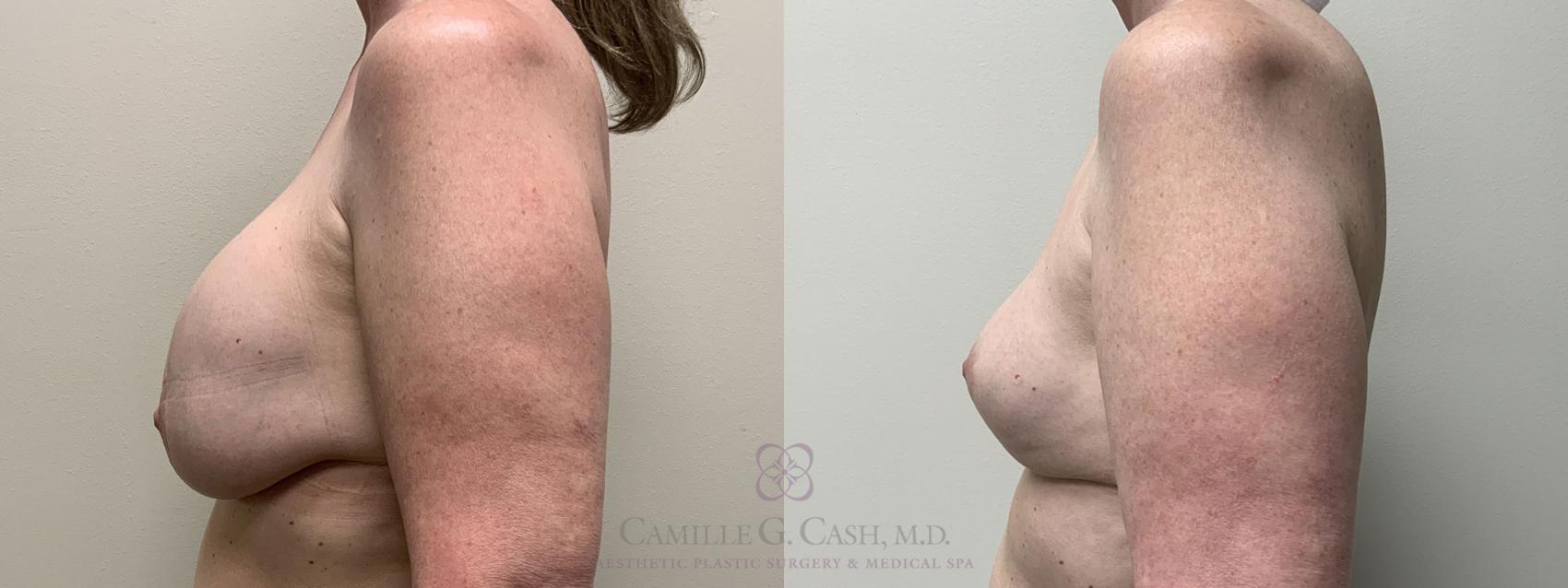 Before & After Breast Implant Removal Case 419 View #4 View in Houston, TX