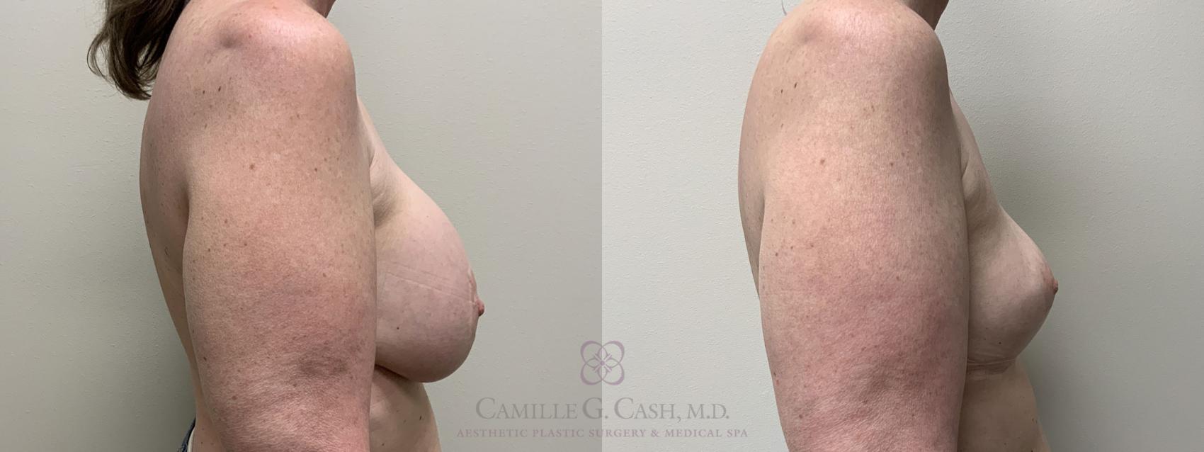 Before & After Breast Implant Removal Case 419 View #5 View in Houston, TX