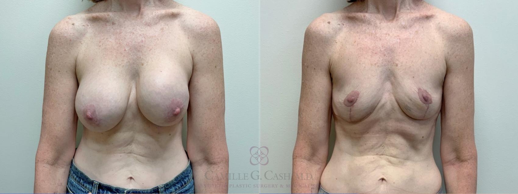 Before & After Breast Implant Removal Case 507 Front View in Houston, TX