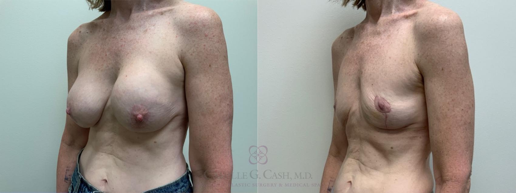 Before & After Breast Implant Removal Case 507 Left Oblique View in Houston, TX