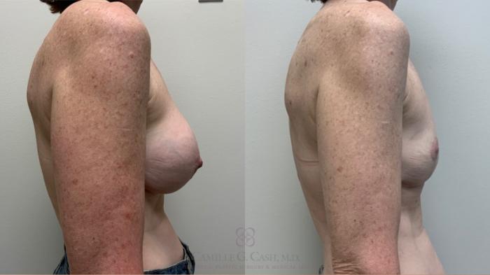 Before & After Breast Implant Removal Case 507 Left Side View in Houston, TX