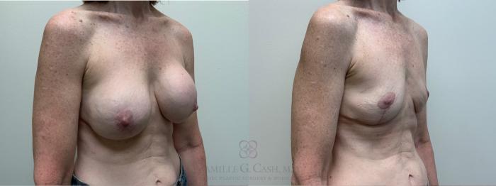Before & After Breast Implant Removal Case 507 Right Oblique View in Houston, TX