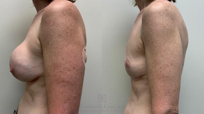 Before & After Breast Implant Removal Case 507 Right Side View in Houston, TX