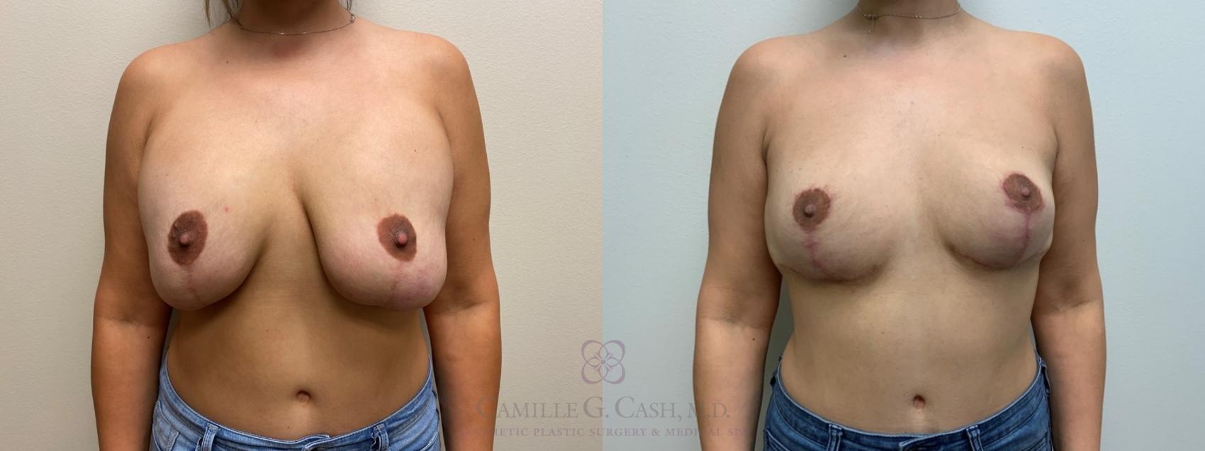 Before & After Breast Implant Removal Case 565 Front View in Houston, TX