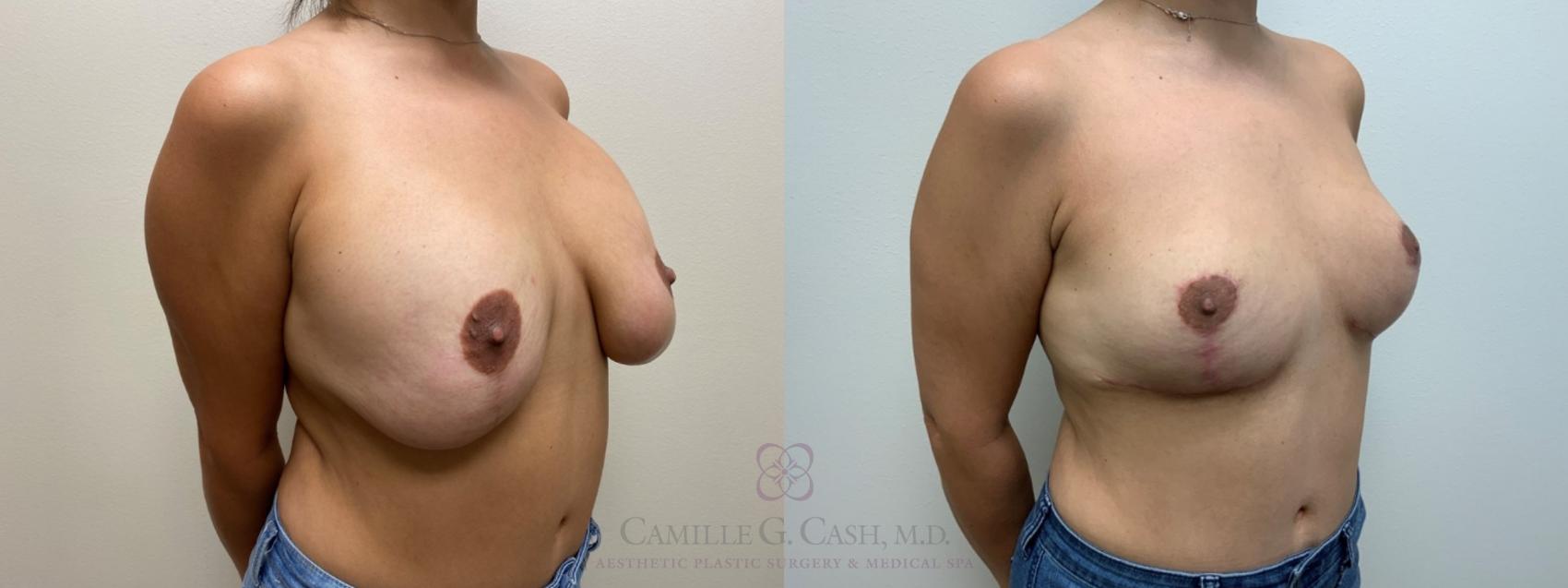 Before & After Breast Implant Removal Case 565 Left Oblique View in Houston, TX