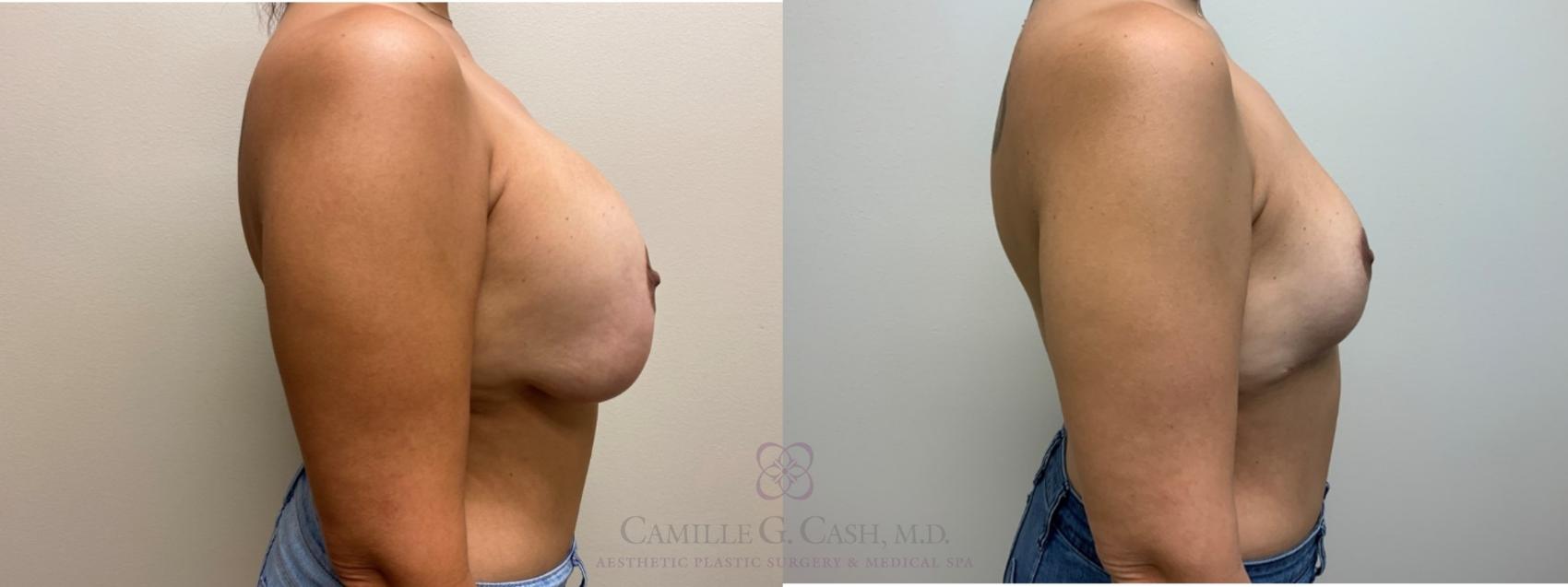 Before & After Breast Implant Removal Case 565 Left Side View in Houston, TX