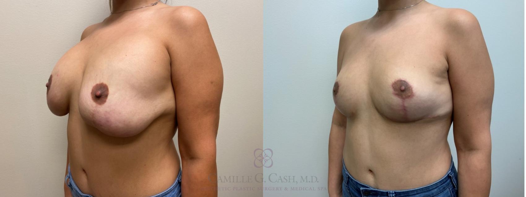 Before & After Breast Implant Removal Case 565 Right Oblique View in Houston, TX