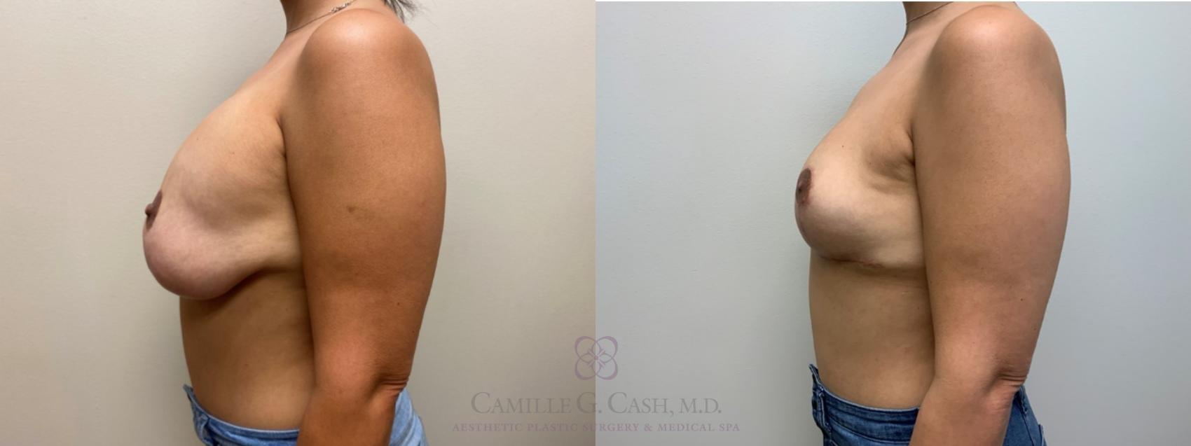 Before & After Breast Implant Removal Case 565 Right Side View in Houston, TX
