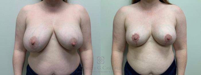 Before & After Breast Implant Removal Case 651 Front View in Houston, TX