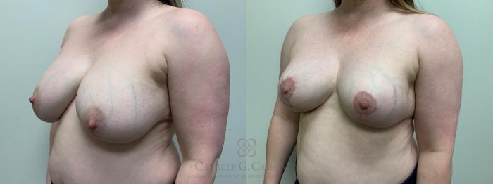 Before & After Breast Implant Removal Case 651 Left Oblique View in Houston, TX