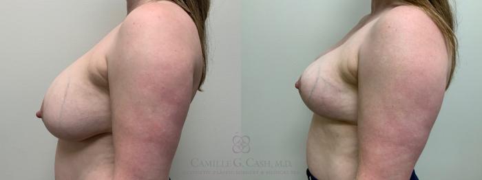 Before & After Breast Implant Removal Case 651 Left Side View in Houston, TX