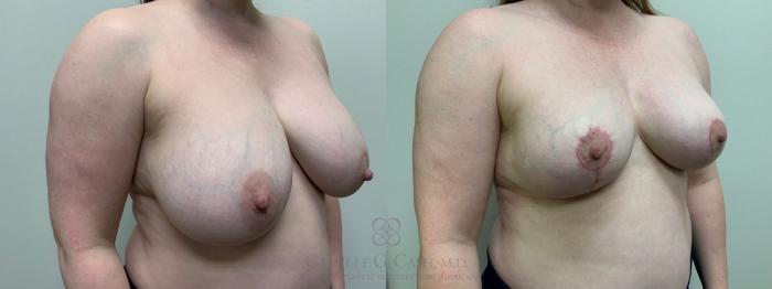 Before & After Breast Implant Removal Case 651 Right Oblique View in Houston, TX
