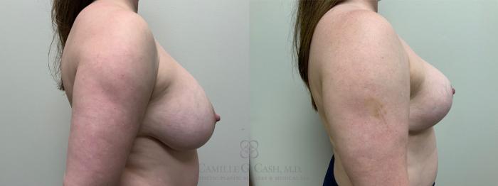 Before & After Breast Implant Removal Case 651 Right Side View in Houston, TX