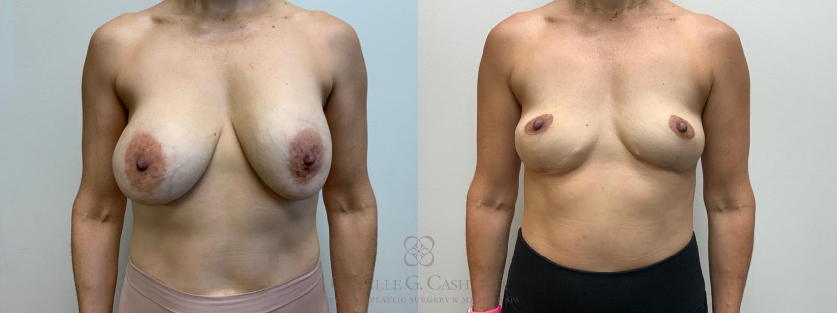 Before & After Breast Implant Removal Case 659 Front View in Houston, TX
