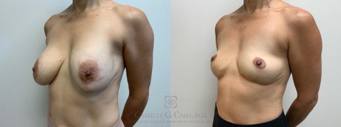 Before & After Breast Implant Removal Case 659 Left Oblique View in Houston, TX