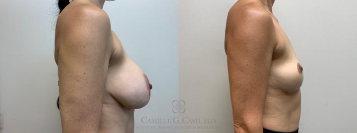 Before & After Breast Implant Removal Case 659 Left Side View in Houston, TX