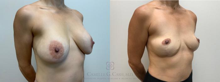 Before & After Breast Implant Removal Case 659 Right Oblique View in Houston, TX