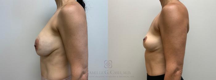 Before & After Breast Implant Removal Case 659 Right Side View in Houston, TX